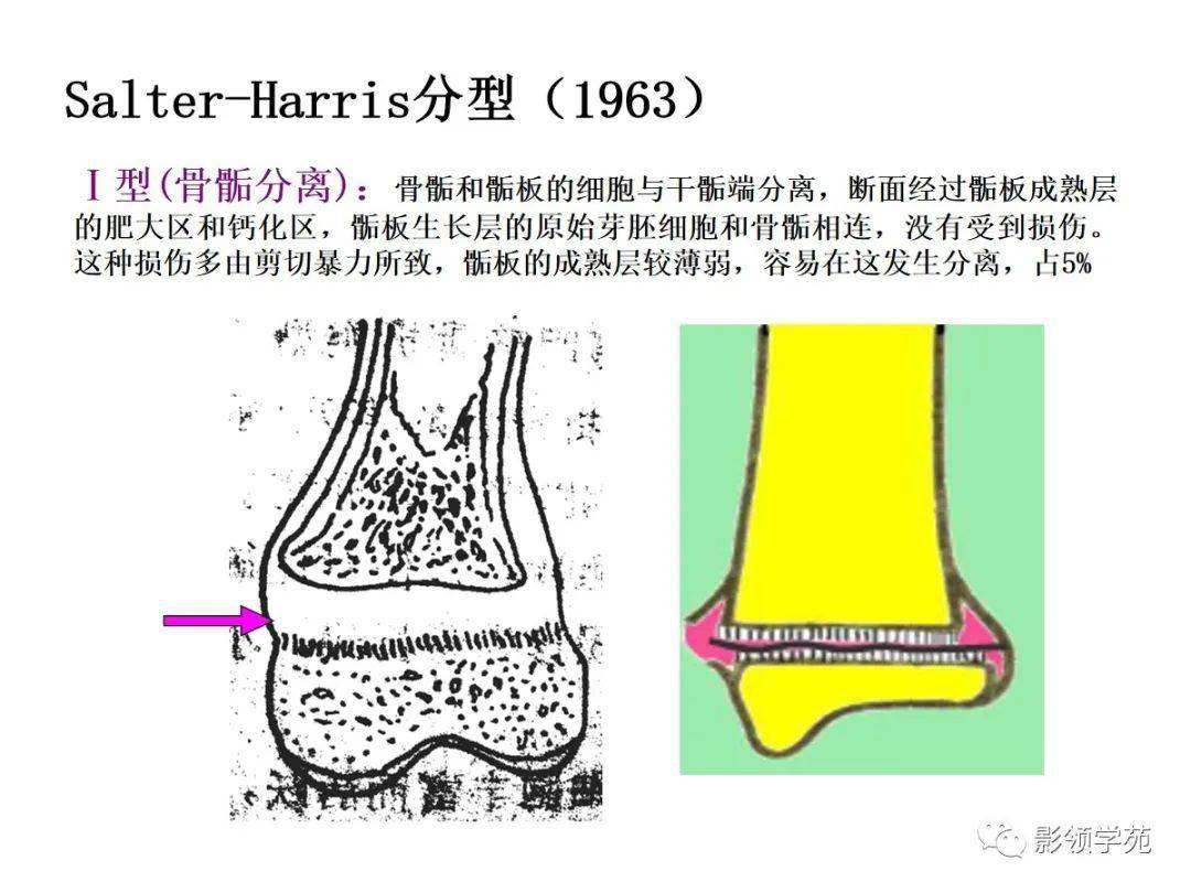 远端全骺分离指肱骨远端包括全部骨骺的软骨块和干骺端之间的分离错位