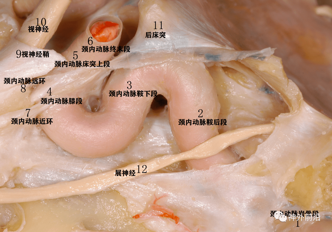 海绵窦三角解剖图图片