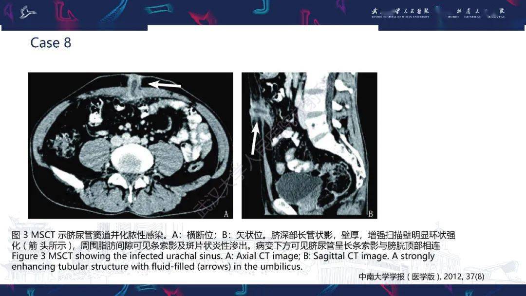 脐尿管病变影像诊断