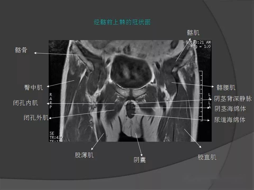 骨盆肌肉解剖mri標識
