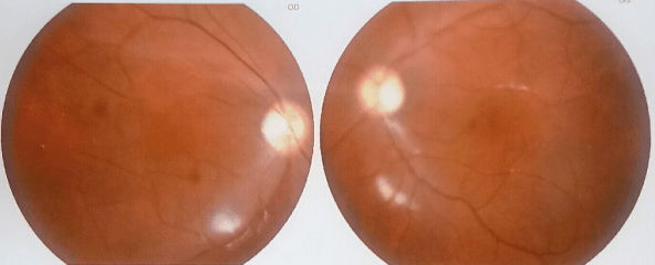 先天性无虹膜患者不再畏光向阳而生