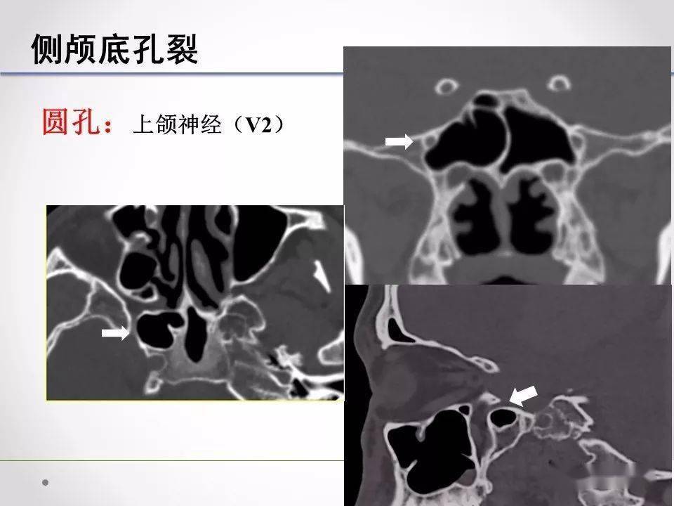 侧颅底临床解剖和影像