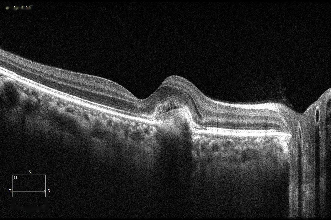 每周最佳病例分享 | 从一个cnv说起