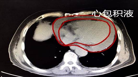 心包积液ct影像表现图片