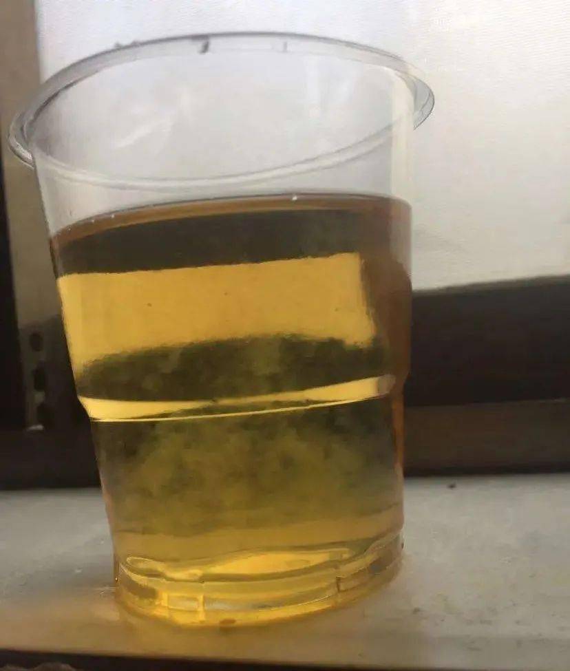 肾病患者为何要检测尿微量白蛋白