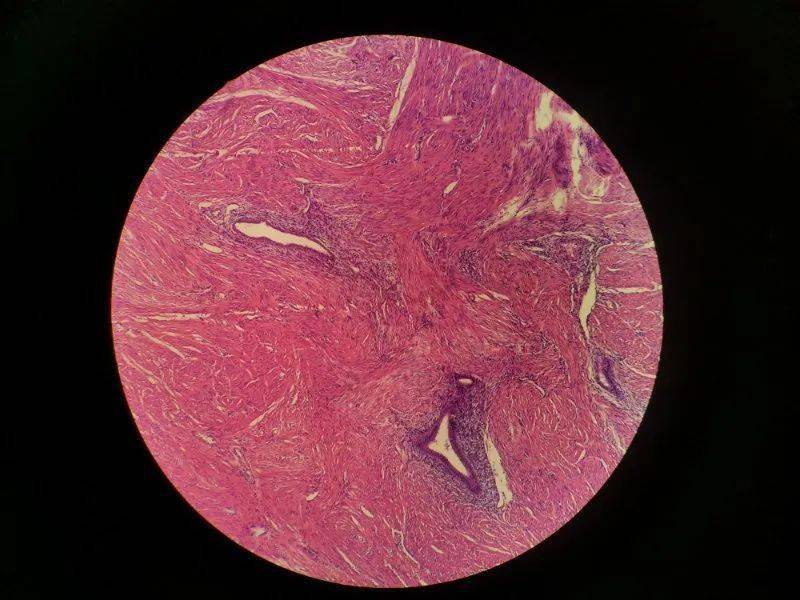 痛经的那些事第一期子宫内膜异位症