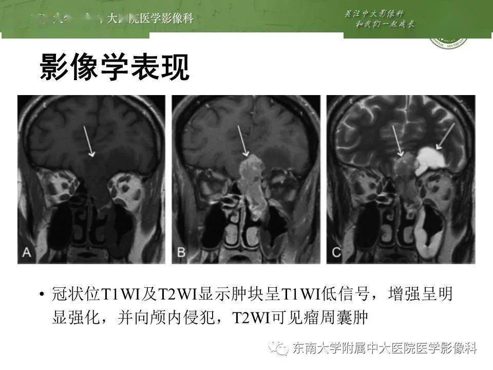 晨读结果公布20200903头颈部疾病嗅神经母细胞瘤