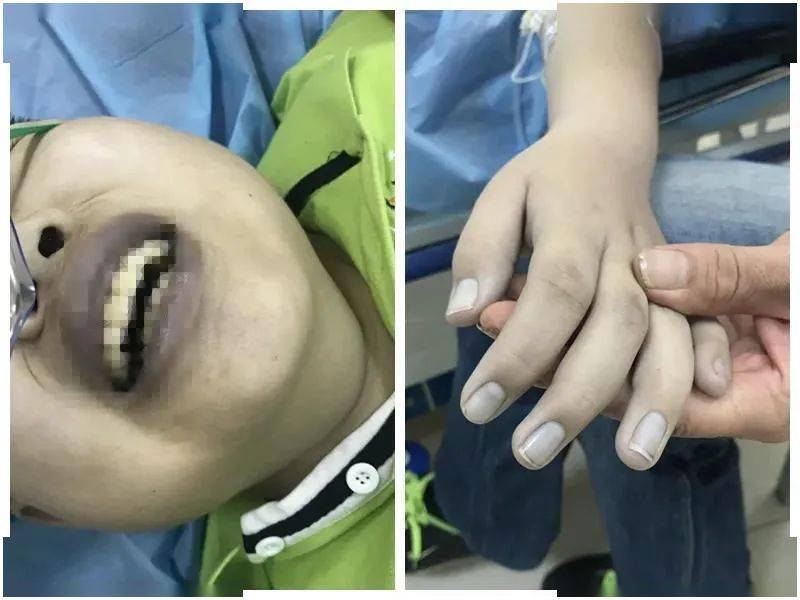 区医院收治小患者面无血色,竟是因为吃了这些_亚硝酸盐