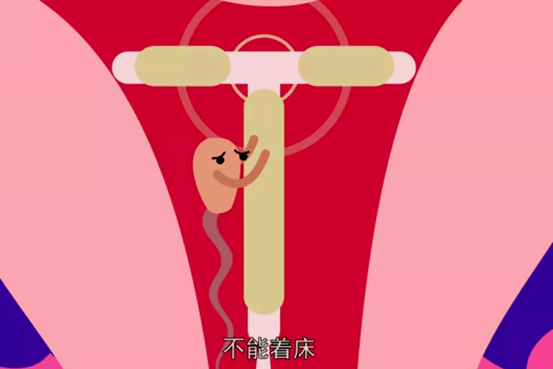 避孕环避孕原理动画图片