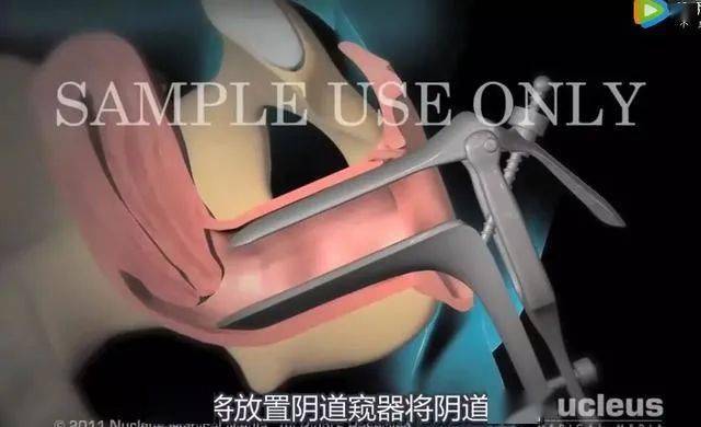 宫腔镜检查,你了解吗?