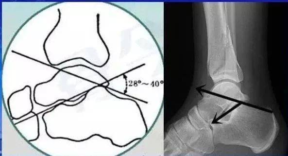 跟骨结节关节角(bohler角)即跟骨结节上缘(跟骨结节与跟骨后关节突的