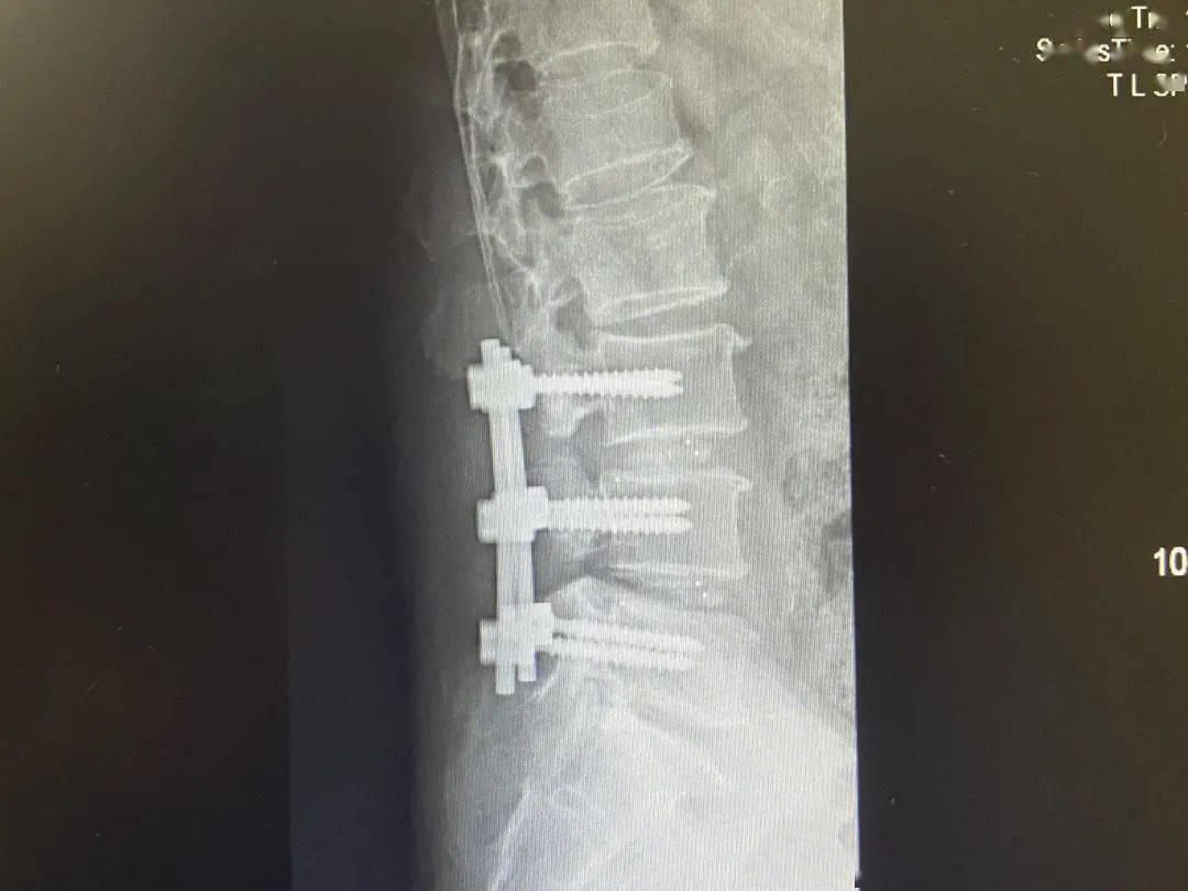 腰椎手术钢钉图片图片