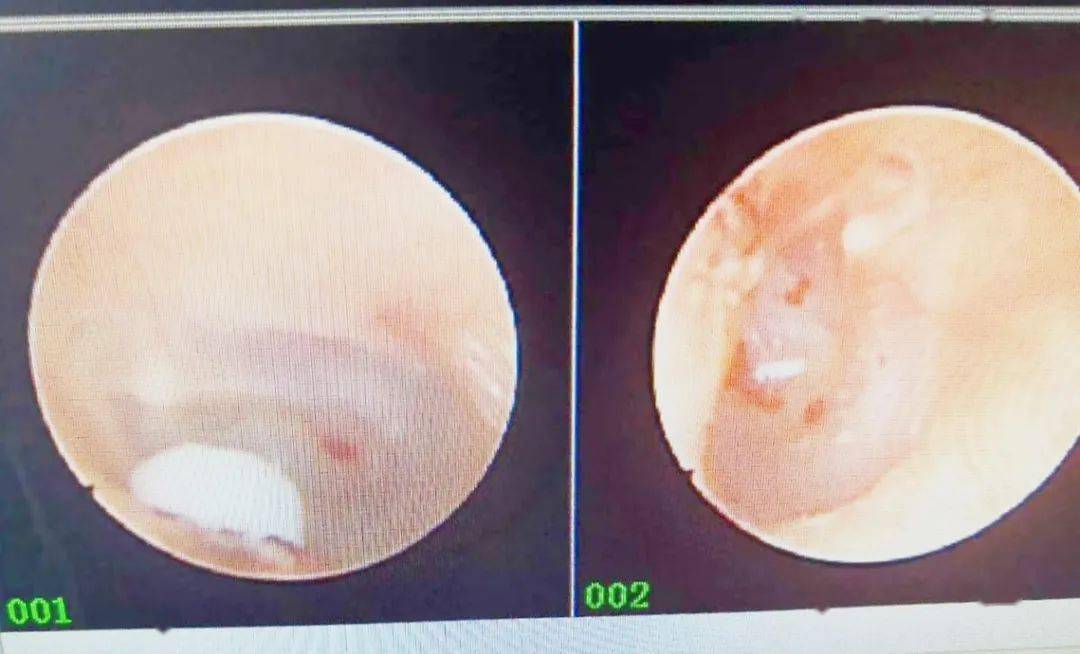 在内镜室,刁护士用耳内镜检查,发现贴近鼓膜处有一白色异物,用专用