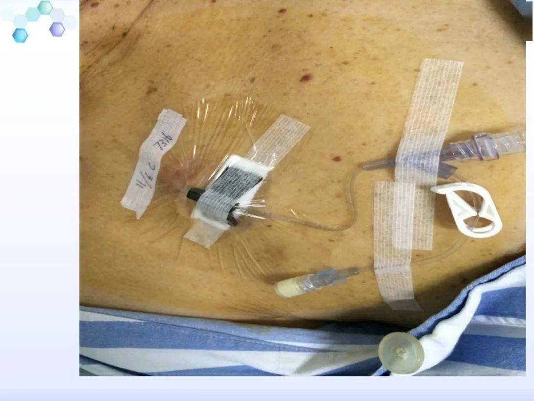 【ppt】输液港的维护和并发症护理