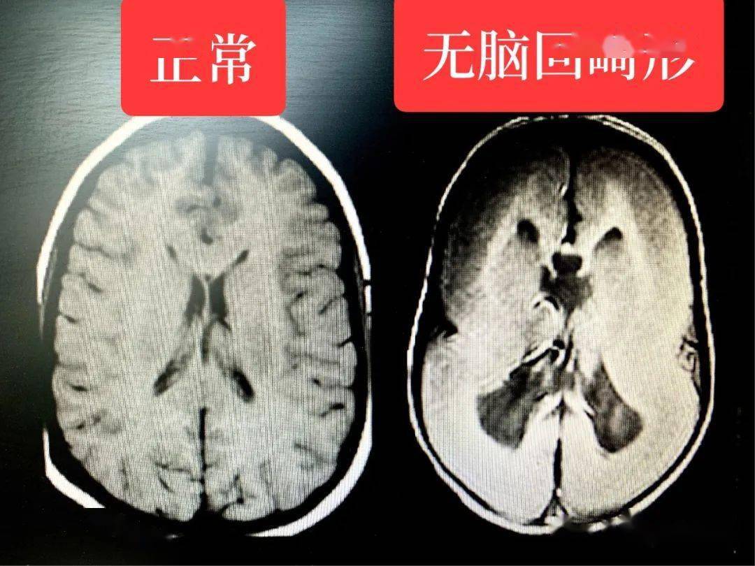 胎儿无脑回畸形