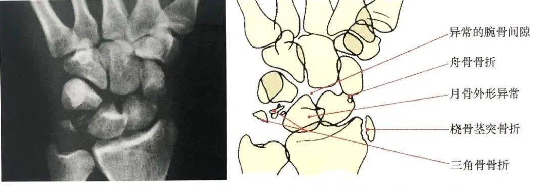 腕關節脫位及其x片閱讀技巧_腕骨