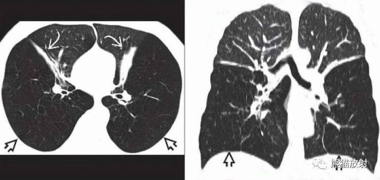 全小葉型/間隔旁型肺氣腫丨ct診斷要點