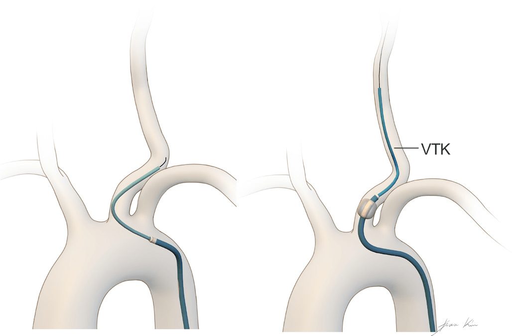 在头颈部血管近端迂曲的情况下,尝试推进glidewire导丝或vitek导管