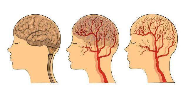 脑供血不足有三大症状图片