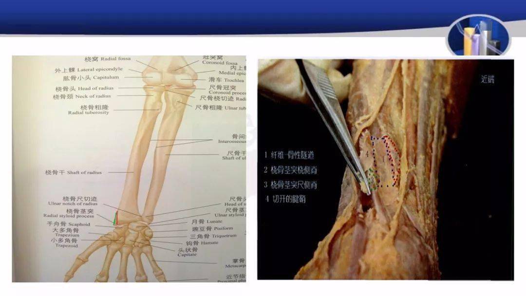 为较小的梭形肌,在拇长展肌起点的下方起自桡骨背面及其附近的骨间膜