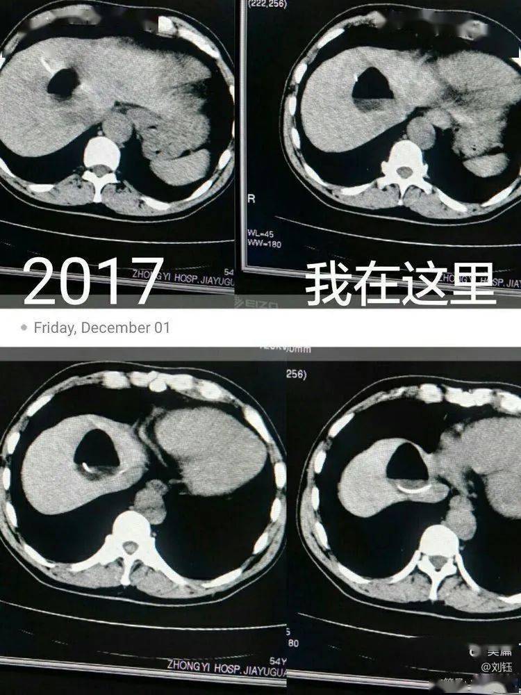 聚桂醇泡沫硬化劑治療肝囊腫效果顯著