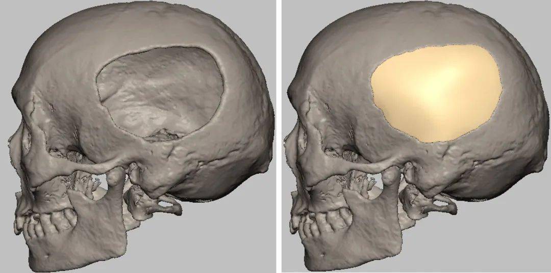 男子颅骨缺损州医院用新型材料完美修复