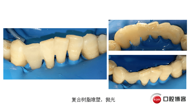 树脂粘接桥的临床运用