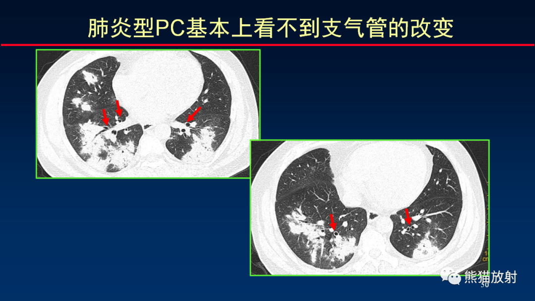 柳澄講壇丨關於肺隱球菌病ct診斷的思考