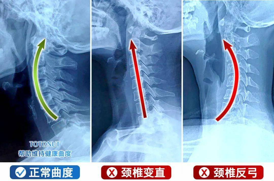 世界冠軍力讚的牽引枕每天靠一會兒頸椎再也不累