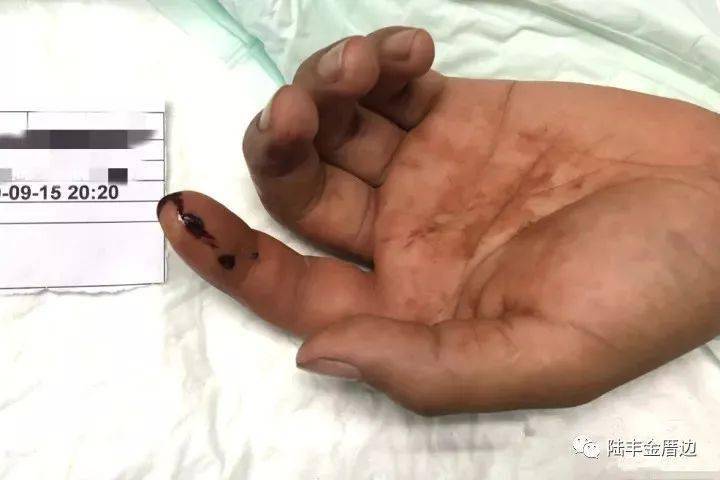 恐怖陆丰一男子被毒蛇咬伤