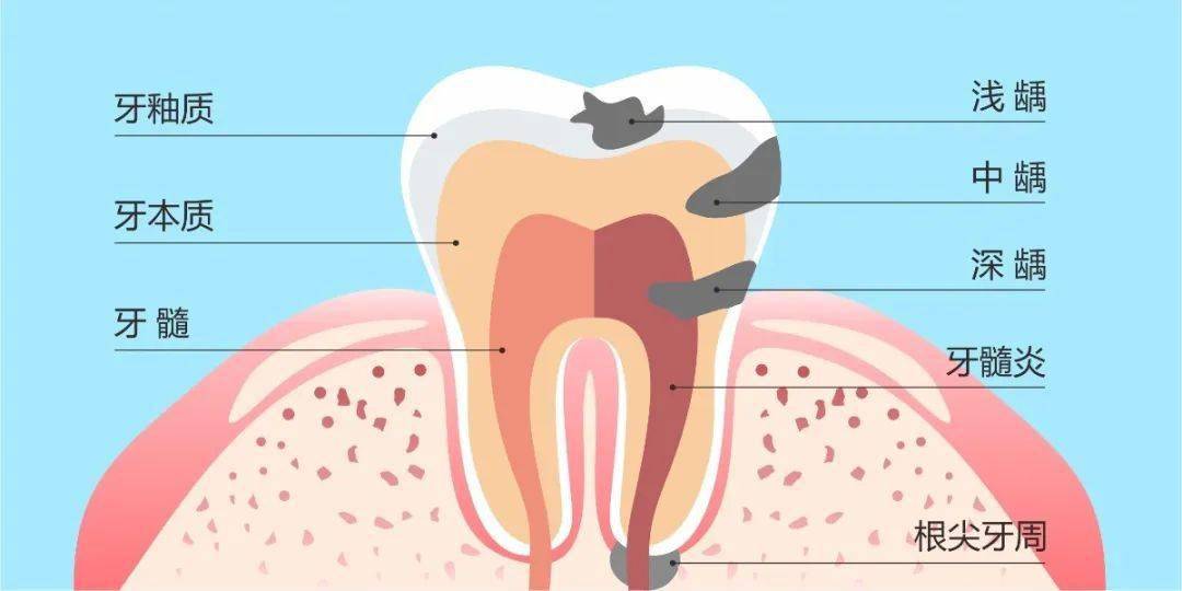 從淺齲發展到深齲再到根尖炎,齲齒若不進行及時治療,這樣可以阻止齲病