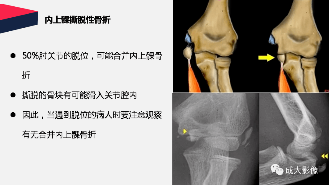 兒童常見肘關節骨折x線表