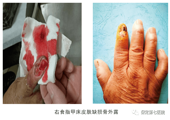 【科普】人工真皮支架