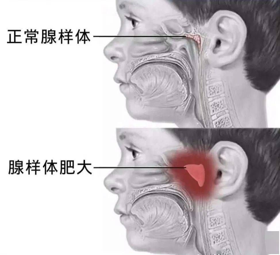 健康生活必读 | 孩子变丑变笨可能都是因为它 家长们千万别忽视!