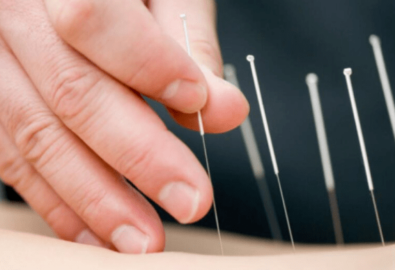 健康中医特色治疗之针灸一