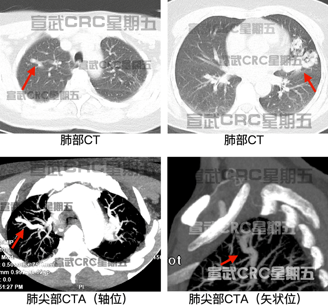 宣武crc星期五丨国际首例急诊取栓之肺动静脉畸形反常栓塞