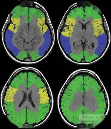 硬货收藏6张图完美解释大脑静脉系统mrv及各自引流区域