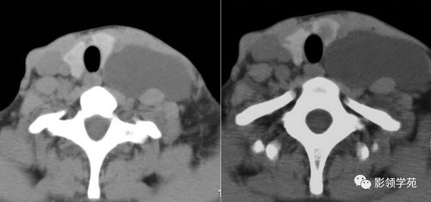 皮样囊肿:临床特征:舌骨中线缓慢生长肿块,质软,与皮肤不粘连.