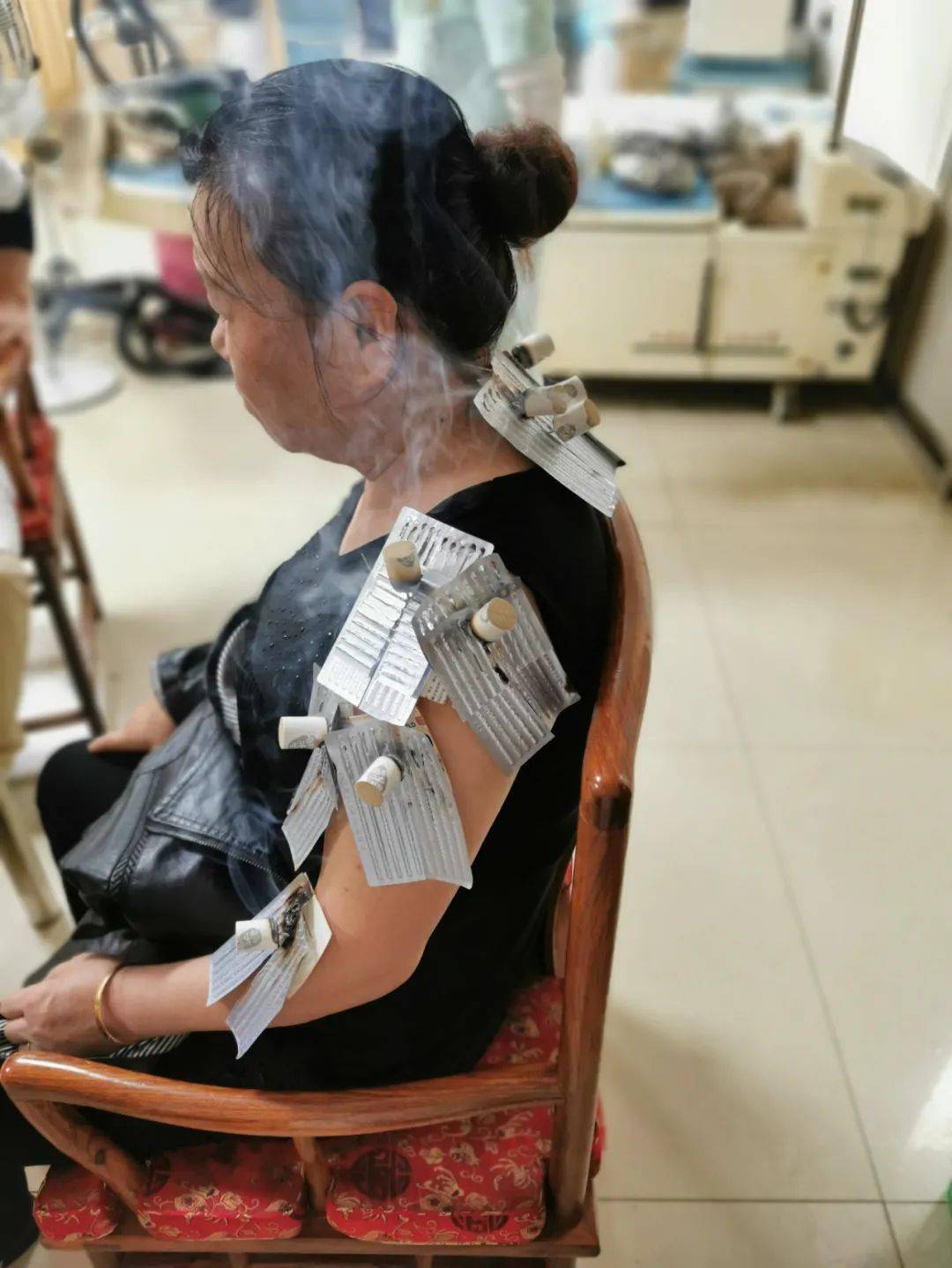 治疗中经温针灸治疗三天后,症状明显缓解,左上肢上举无障碍.