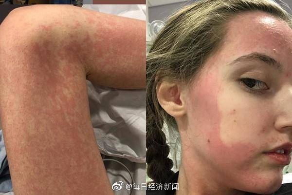 对所有食物过敏英女子靠心脏输液维生