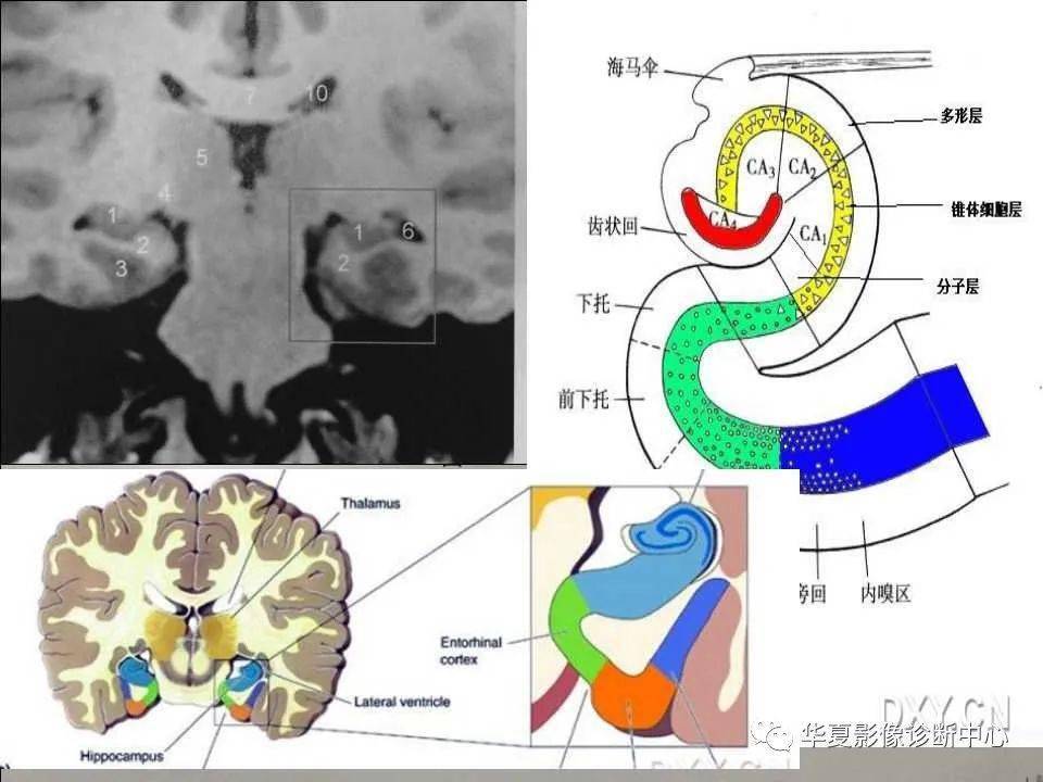 核磁共振海马解剖图图片