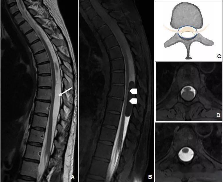 椎管内囊性病变影像诊断和分类