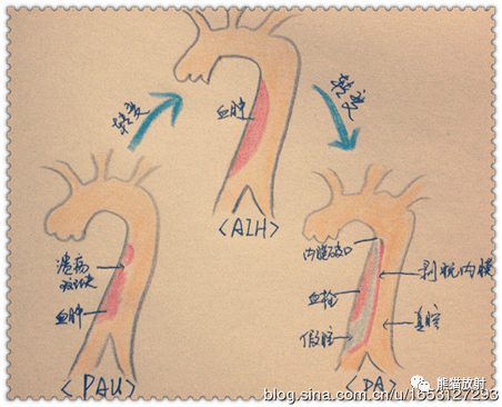 主动脉夹层/壁间血肿/穿透性溃疡,啥关系,咋区分