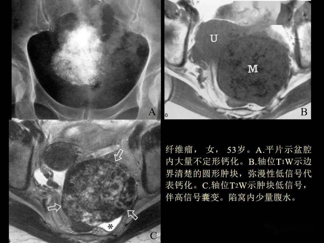 女性盆腔肿瘤影像诊断