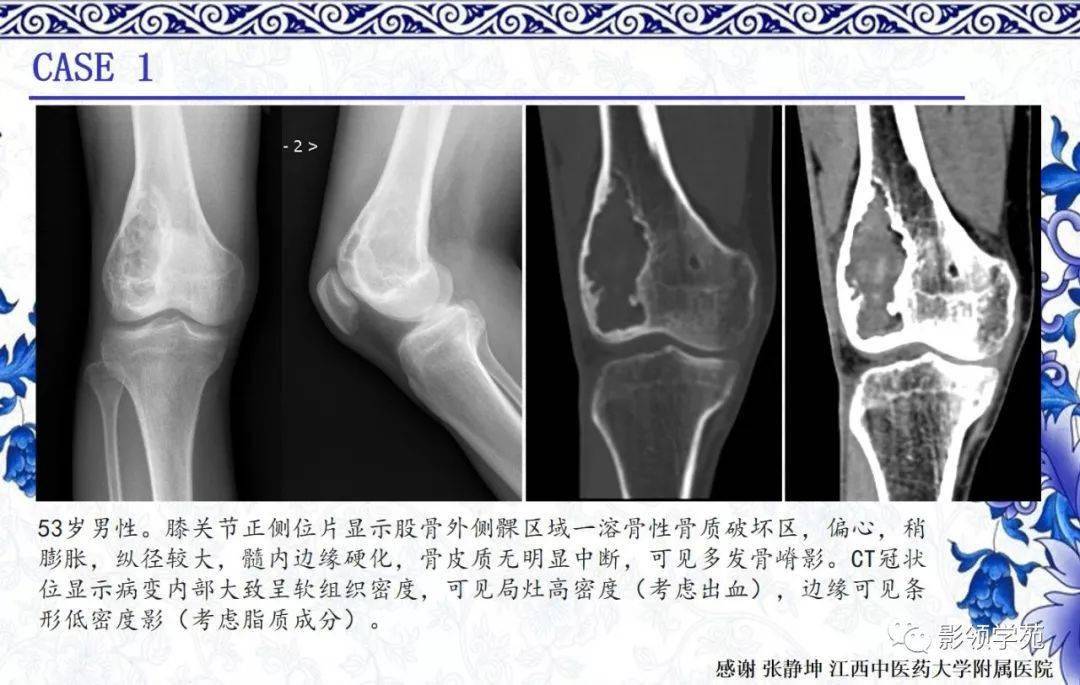 非骨化性纤维瘤CT图片图片