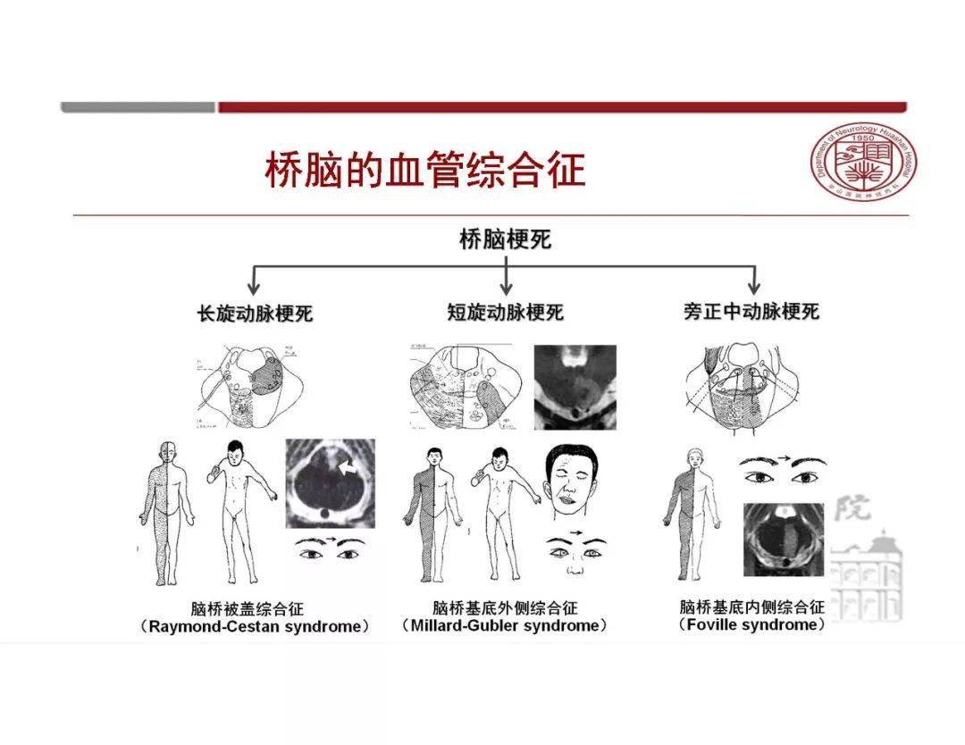 腦血管解剖太複雜一文教你輕鬆掌握