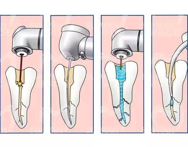 根管治疗拯救判死刑的牙齿