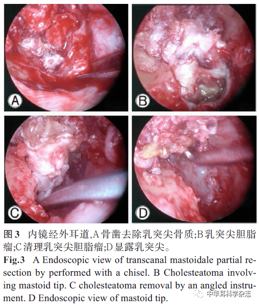 中耳胆脂瘤在耳内镜下手术治疗的探讨