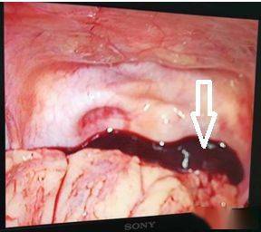 典型和不典型的宫外孕超声表现你都要掌握哦
