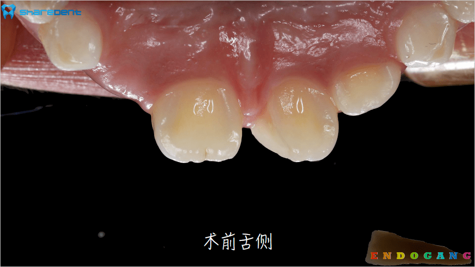 21必兰局麻后牙龈修整,上障,折断面喷砂清洁处理,2%洗必泰冲洗消毒修